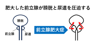 前立腺肥大_圧迫図