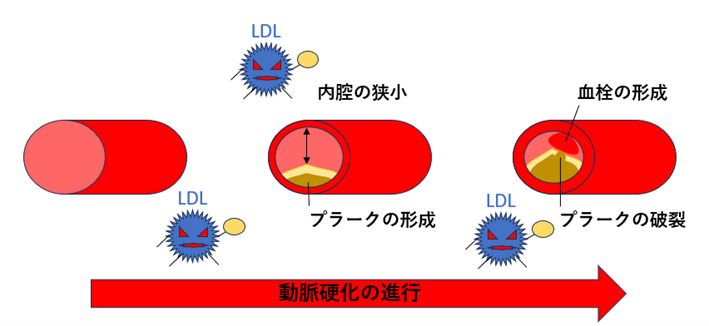 ●画像（脂質異常症_動脈硬化）