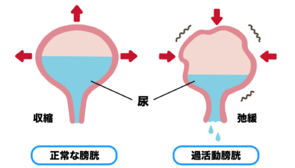 過活動膀胱